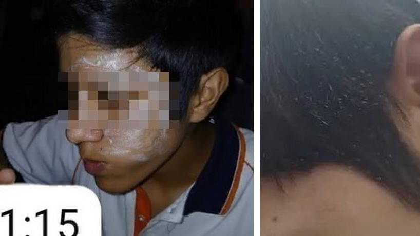 Violencia escolar en Banda del Río Salí: un alumno sufrió quemaduras tras una “llamarada” en el aula
